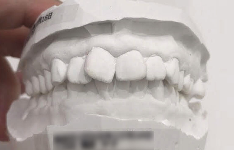 歯の模型（正面の嚙み合わせ）