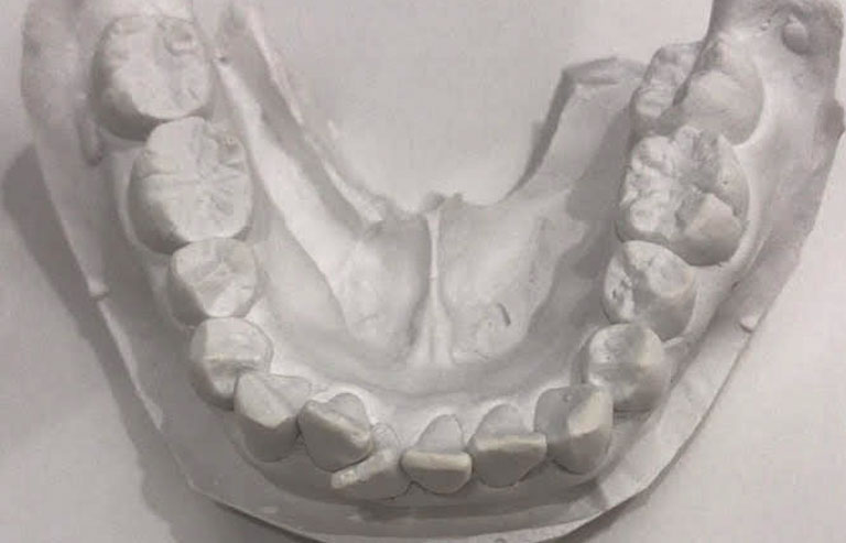 歯の模型（下の歯）