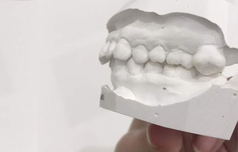 歯の模型（左側から）