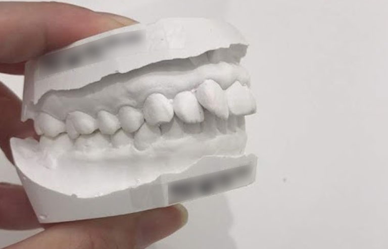 歯の模型（右側から）