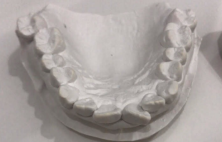歯の模型（上の歯）
